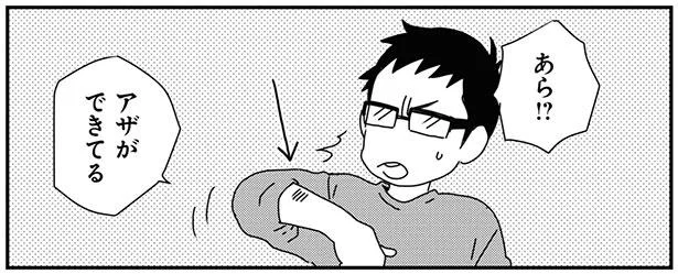 アザができてる