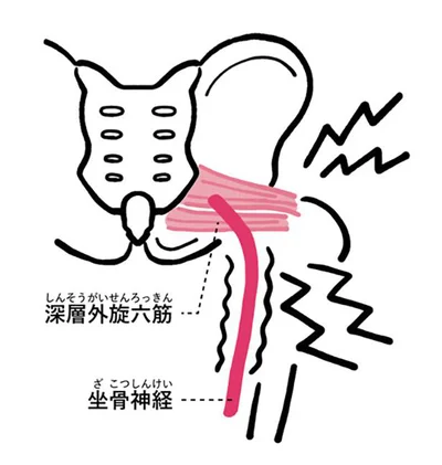 カチカチの筋肉が神経を締めつけて痛みが発生！