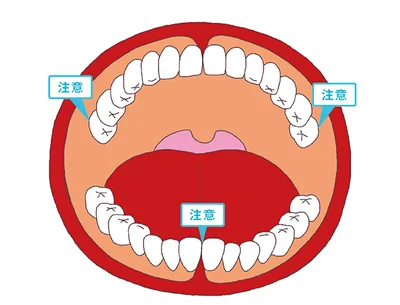 歯の根元は歯垢が残りやすく、また上の奥歯の外側や下の前歯の裏側など、唾液腺の近くに歯垢が残ると石灰化して歯石になりやすいので、磨き残しには要注意。