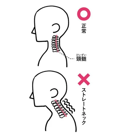 首がストレート化して頸髄（神経）が圧迫され、コリや痛みに
