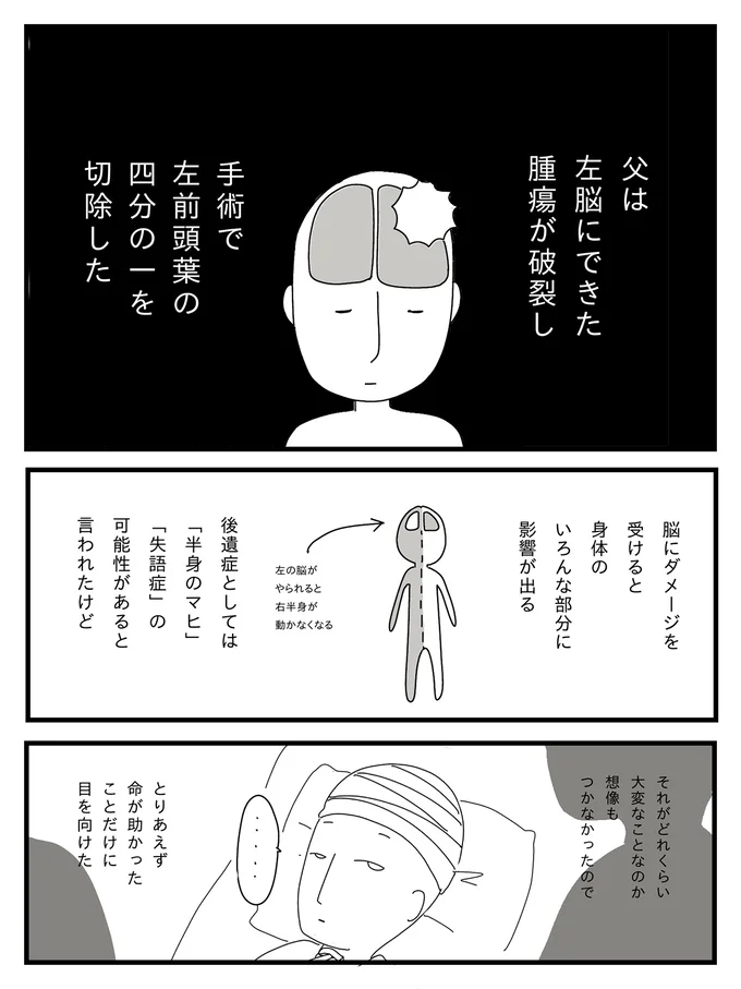 手術で左前頭葉の4分の1を切除した