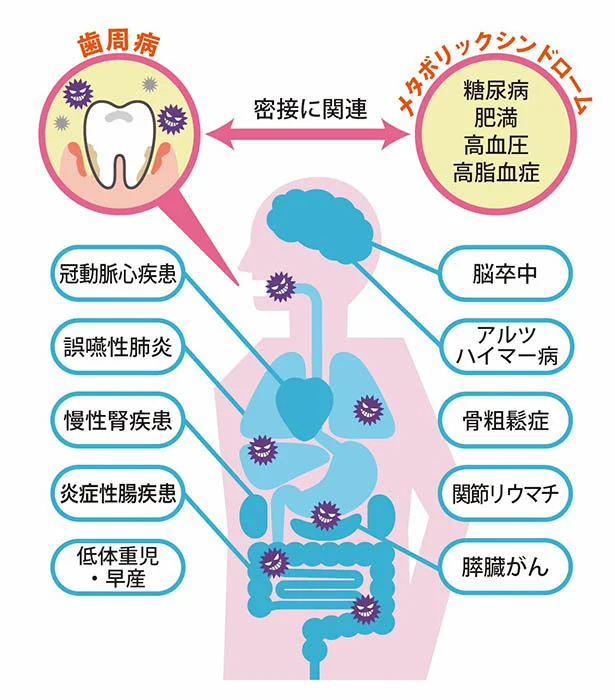 口の中の悪玉菌のひとつ・歯周病菌だけで、これほど全身疾患に悪影響が！