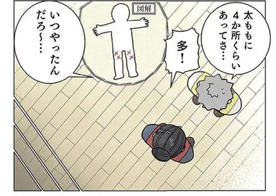 太ももにアザが…いつやったんだろ～