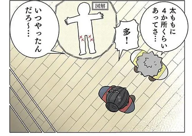 原因はこれだわ。先生の太ももに謎のアザができていた理由／保育士でこ先生4（12）