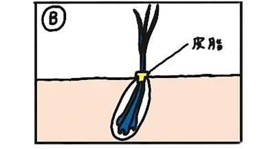 毛穴に皮脂などが詰まると、複数本の毛髪を結束バンドで固定したような状態になり、毛量が少なく見える。