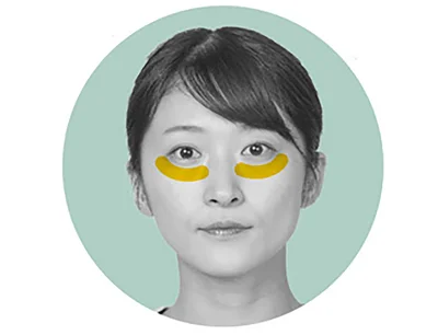 目の下部の眼輪筋剥がし