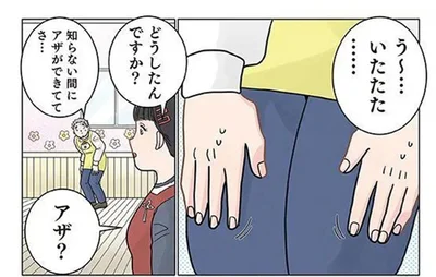 らない間に保育士の太ももにアザが！ 翌日判明した「原因」は？