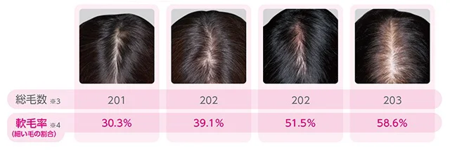 【写真】分け目が透ける状態(壮年性脱毛症)とは?