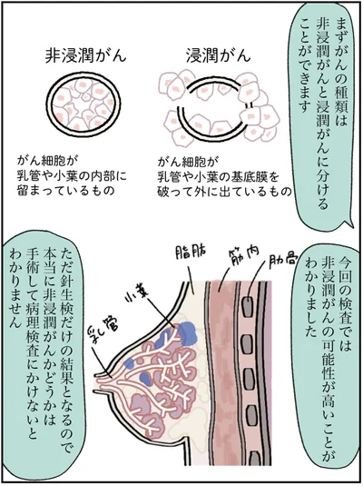 非浸潤がんの可能性が高いことがわかりました