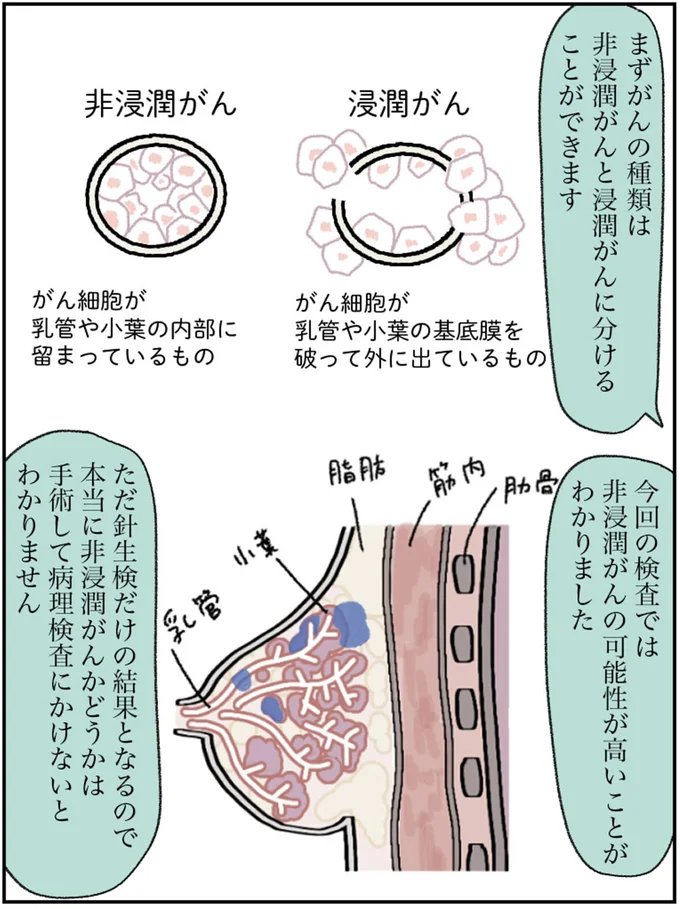 非浸潤がんの可能性が高いことがわかりました