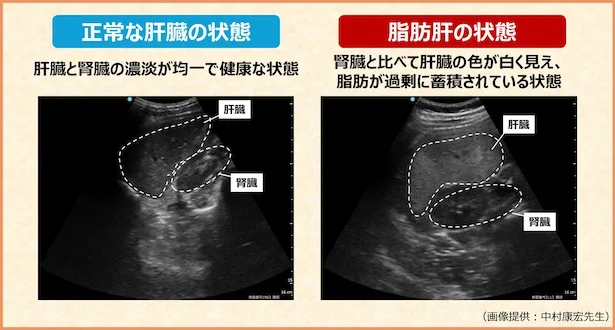 脂肪肝エコー画像