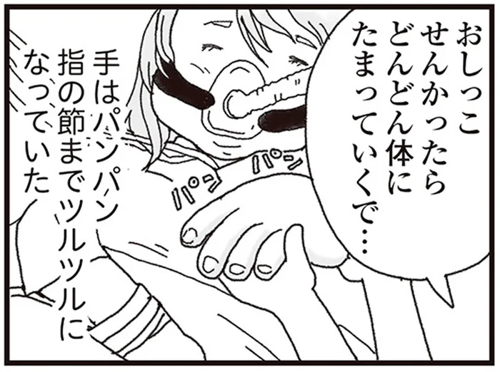 妻の闘病が始まり2週間。排尿がなく、全身が水分でパンパンに／私がシングルファザーになった日（13）