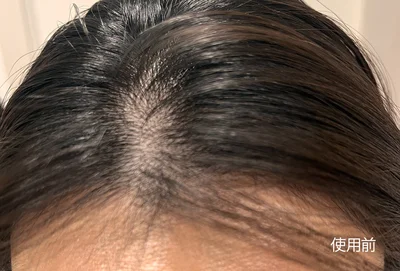 ロクシタン メディカル アンチヘアロスセラム使用前