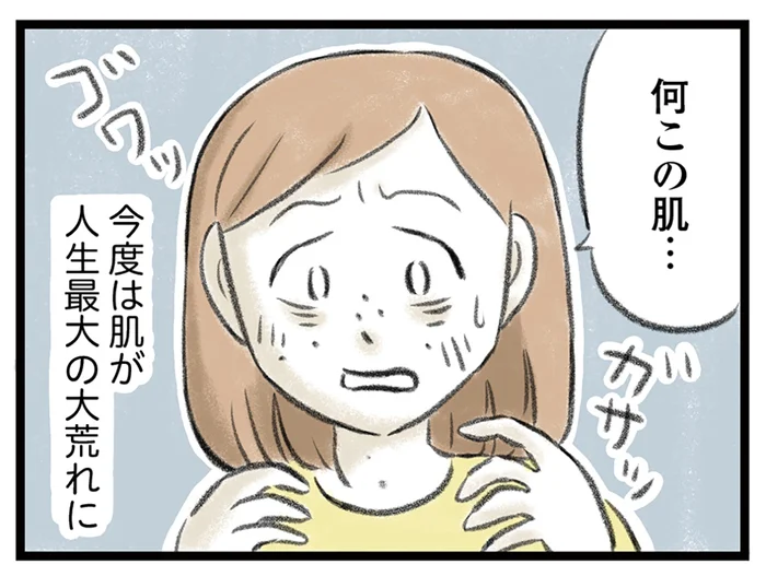 寝不足や疲れ、さらに過食で肌が大惨事に！ うつ病の夫を支える妻の変化／夫婦で心を病みました（6）