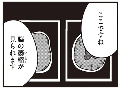 脳の萎縮が見られます