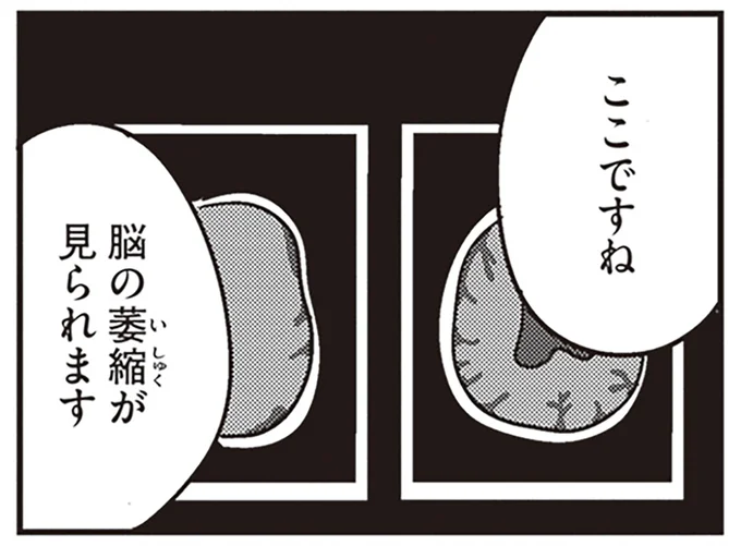 脳の萎縮が見られます