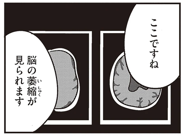 「脳の萎縮が見られます」若年性認知症と診断された夫の隣で妻は呆然／夫がわたしを忘れる日まで（7）