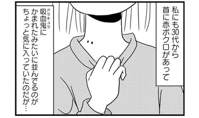 首の赤ボクロが気になる! 皮膚科の日帰り手術でドキドキ