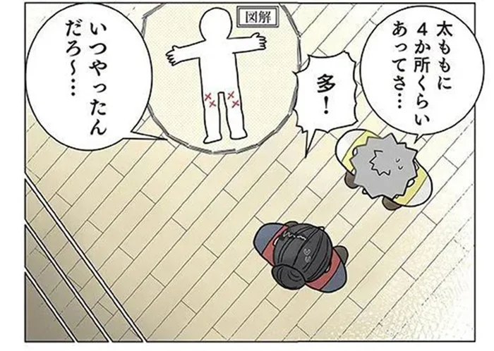 こんなところになぜ？ 保育士の太ももに4か所もアザができていたワケ