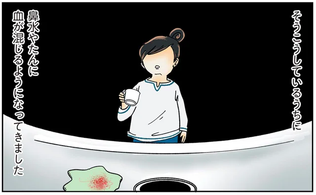 長引く風邪を市販薬で乗り切る日々。ついに鼻水に血が混じるように／鼻腔ガンになった話（2）