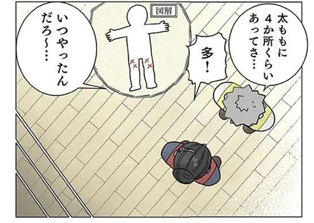 こんなところになぜ？ 保育士の太ももに4か所もアザができていたワケ