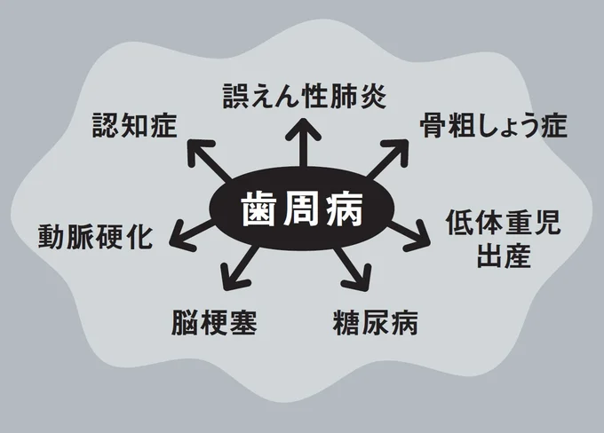 〝汚口〞を放っておくと歯周病から全身疾患に