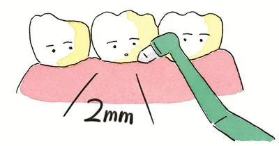 ペン型歯ブラシで歯の境目を2mmの深さでなぞる