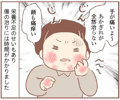あかぎれが全然治らない