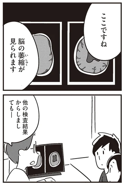 脳の萎縮が見られます