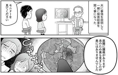 直腸に腫瘍があります