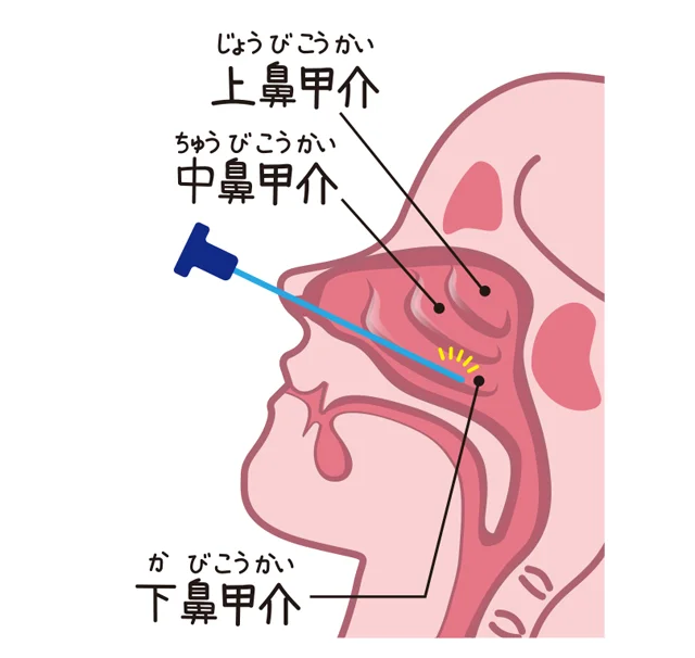 花粉 症 鼻 の 粘膜 焼く