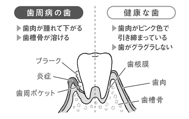 歯周病1