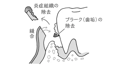 一般的な歯周病手術