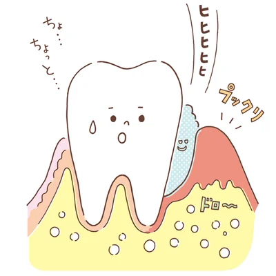 歯を失う原因No.1ともいわれる歯周病