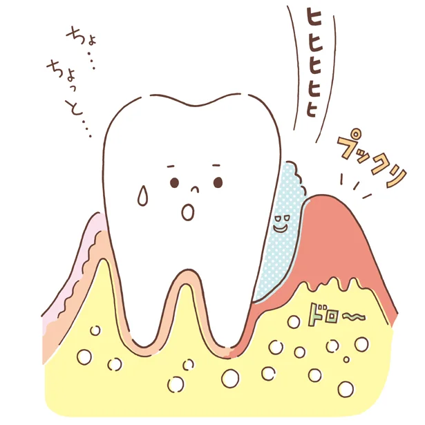 歯を失う原因No.1ともいわれる歯周病