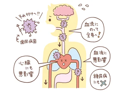 口から入った歯周病菌は、血管を通って体中に回って悪い影響を