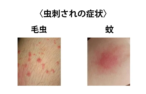 刺されると、こんな症状が！