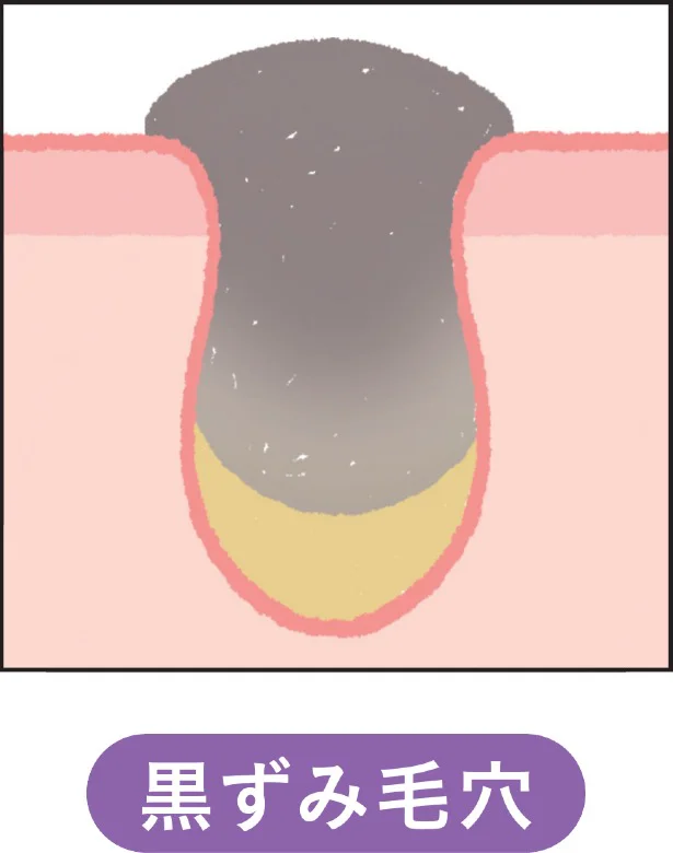 黒ずみ毛穴