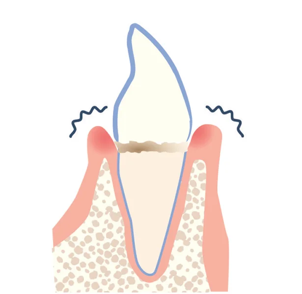 「歯肉炎」…歯ぐきが腫れて血が出る