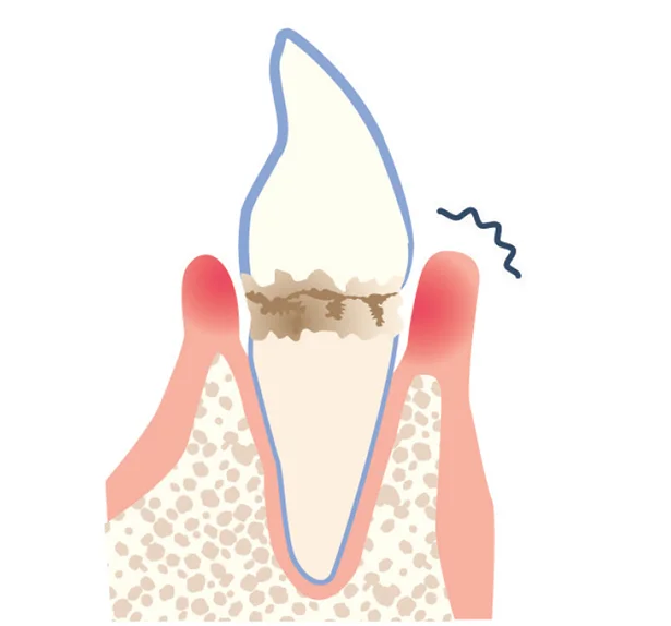 「歯周炎」…骨が溶け歯を失う原因に