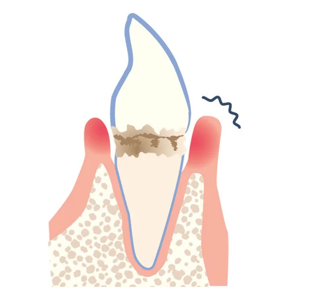 骨が溶け歯を失う！？間違ったホームケアが招く、お口の怖すぎるトラブル レタスクラブ