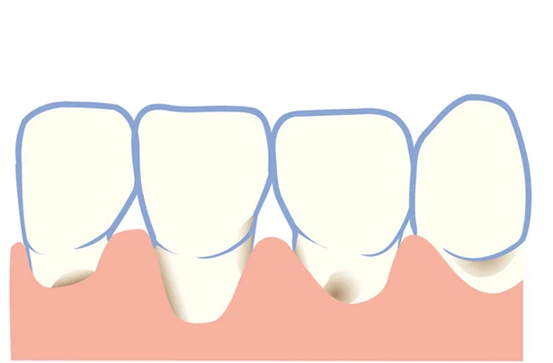 「根面う蝕」…歯ぐきが下がってできる
