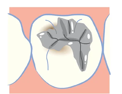 「二次虫歯」…虫歯の治療後にできる