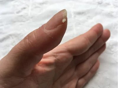 【画像】いたたた…！手荒れだけでなく爪も割れてしまうひどい状態