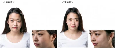 【写真を見る】施術前（左）と施術後（右）で顔の明るさが変わる